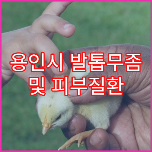 용인시 발톱무좀 및 피부질환 치료 병원